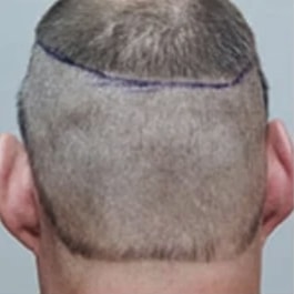 View of the back of man's head, with the back of his hair shaved before the procedure.
