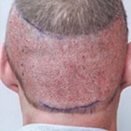 View of the back of man's head, with the back of his hair harvested during the procedure.