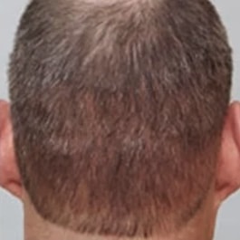 View of the back of man's head, with the hair grown back after the procedure.