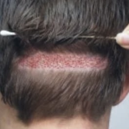 View of the back of man's head, with a horizontal area of hair shaved and harvested.