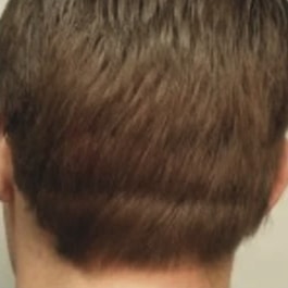 View of the back of man's head, showing how the hair above completely covers the area that was shaved and harvested.