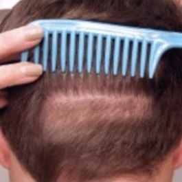 View of the back of man's head, with a comb pulling up the hair to show how some of the hair from the donor area has regrown after the procedure.