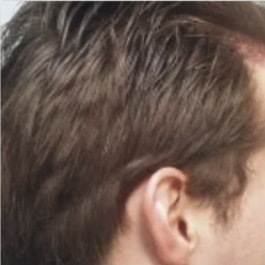 View of the side of man's head, showing how the hair above completely covers the area that was shaved and harvested.