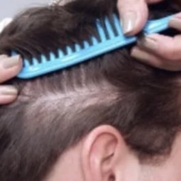 View of the side of man's head, with a comb pulling up the hair to show how some of the hair from the donor area has regrown after the procedure.